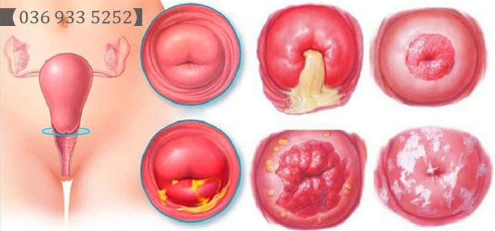 Cổ tử cung viêm đỏ và có mủ nhầy dấu hiệu bệnh gì?