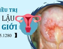 Hình ảnh trước và sau điều trị bệnh lậu ở nữ giới