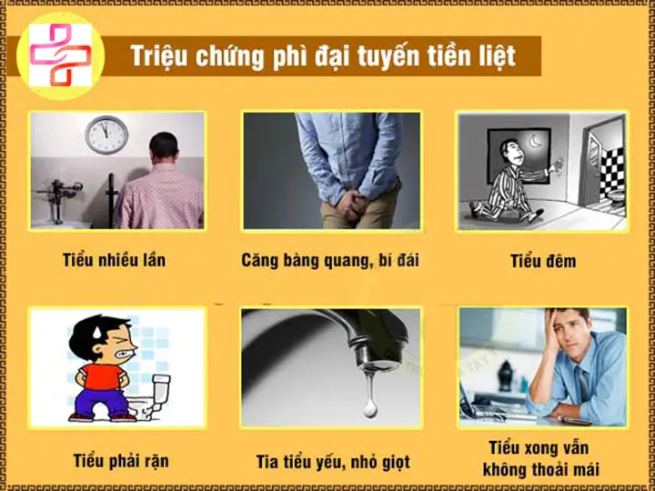 Dấu hiệu phì đại tuyến tiền liệt