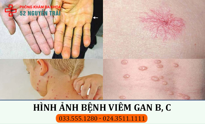 Hình ảnh bệnh viêm gan