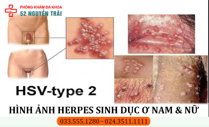 Hình ảnh Herpes sinh dục