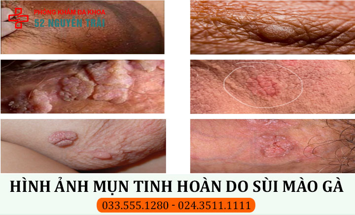 Mụn tinh hoàn do sùi mào gà