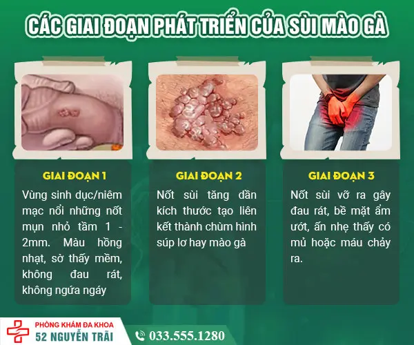 Các giai đoạn phát triển của sùi mào gà