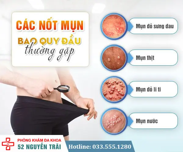 Các mụn ở bao quy đầu hay gặp