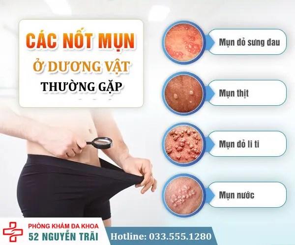 Các mụn ở dương vật thường gặp