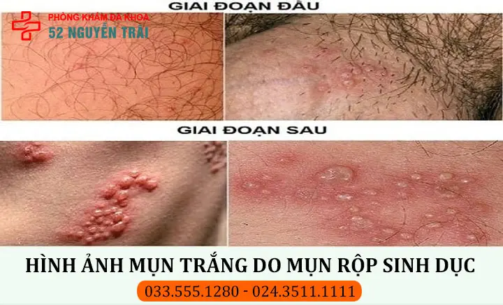 Hình ảnh mụn trắng ở bộ phận sinh dục do bệnh mụn rộp sinh dục