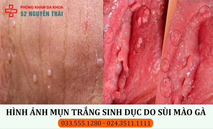 Hình ảnh mụn trắng ở bộ phận sinh dục do sùi mào gà