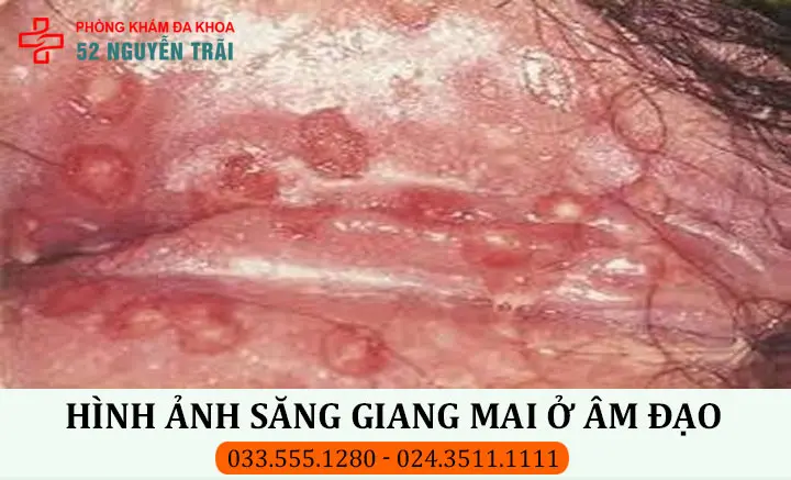 Hình ảnh săng giang mai ở âm đạo