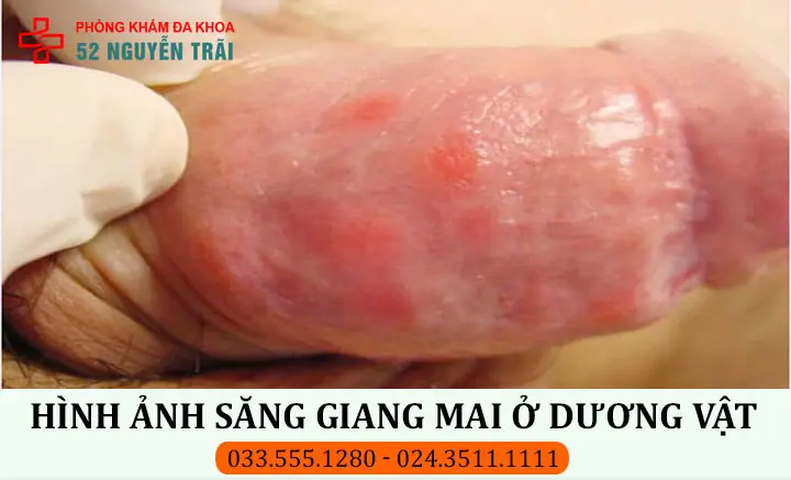 Hình ảnh săng giang mai ở dương vật