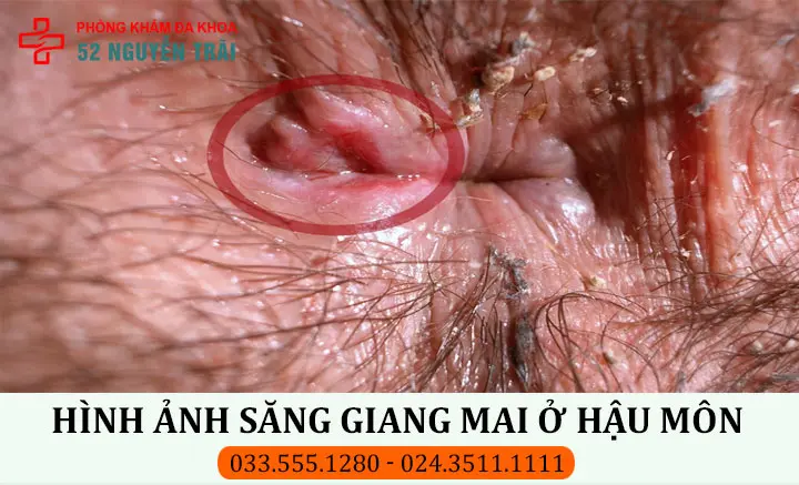 Hình ảnh săng giang mai ở hậu môn