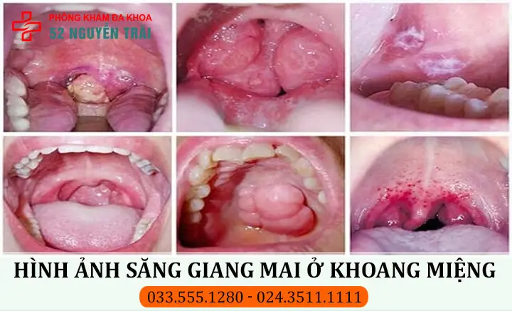 Hình ảnh săng giang mai ở khoang miệng