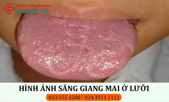 Hình ảnh săng giang mai ở lưỡi