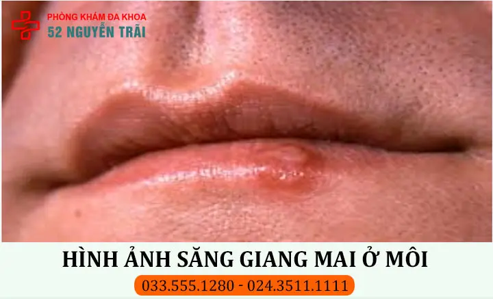 Hình ảnh săng giang mai ở môi