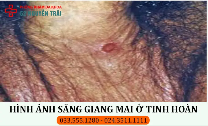 Hình ảnh săng giang mai ở tinh hoàn nam giới