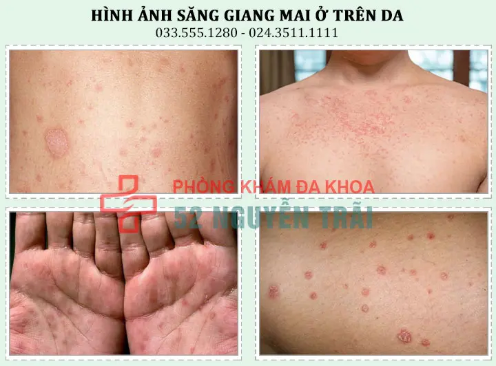 Hình ảnh săng giang mai ở trên da(lưng,ngực,tay,chân)