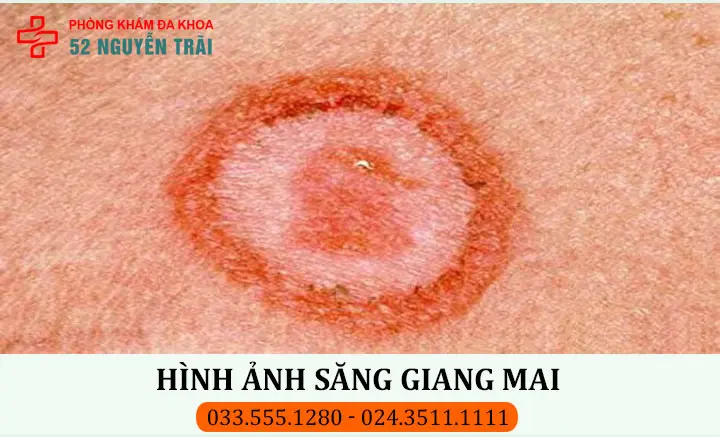 Hình ảnh săng giang mai