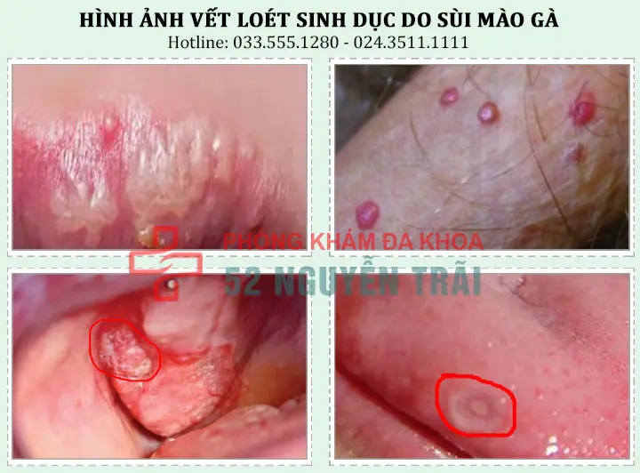 Hình ảnh vết loét sinh dục do sùi mào gà