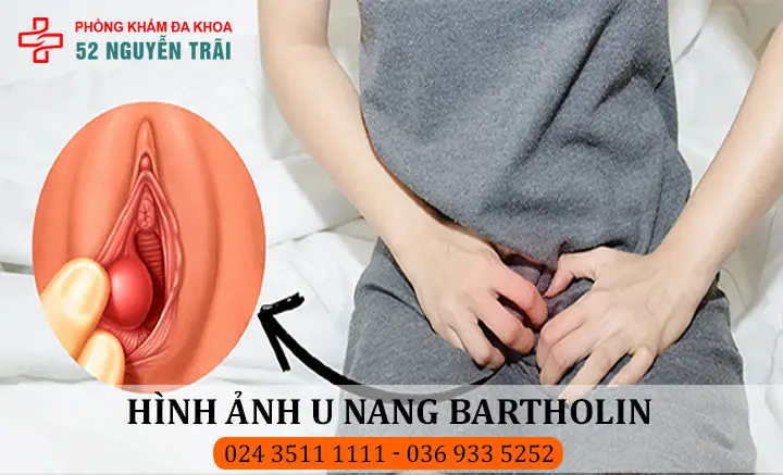 Hình ảnh viêm tuyến bartholin