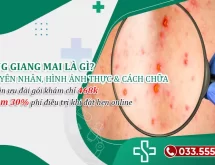 Săng giang mai là gì? Nhận biết nhanh qua 20+ Hình ảnh thực tế từng vị trí