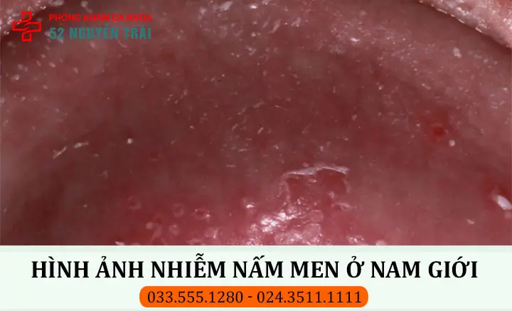 Hình ảnh nhiễm nấm men(nấm Candida) ở nam