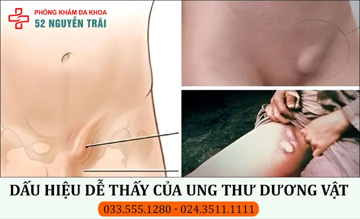 Dấu hiệu dễ thấy của ung thư dương vật