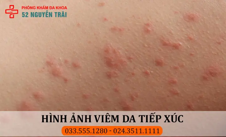 Hình ảnh viêm da tiếp xúc