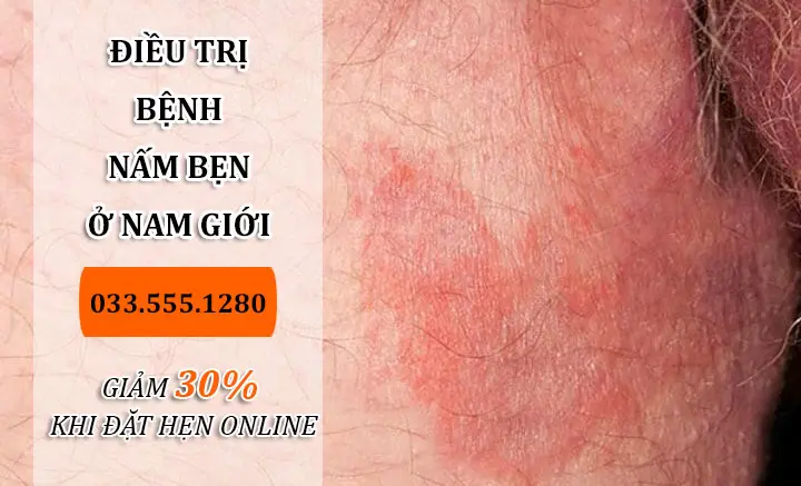 Nấm bẹn ở nam: Nguyên nhân, Triệu chứng & Cách điều trị hiệu quả