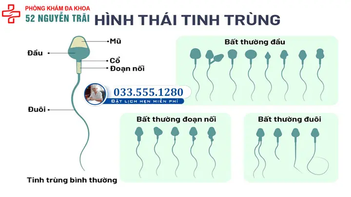 Hình ảnh các hình thái dị dạng của tinh trùng