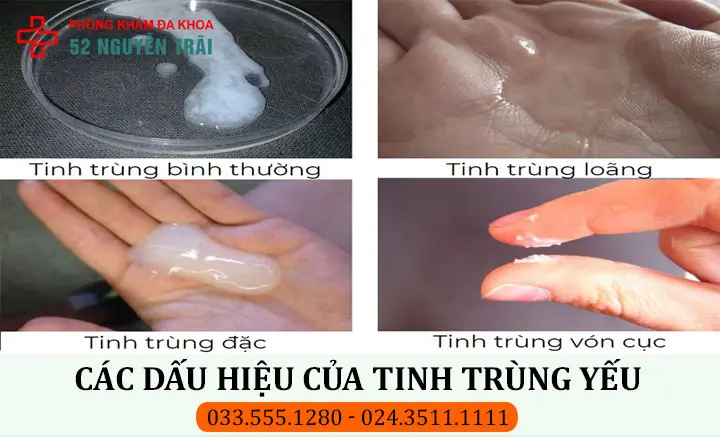 Dấu hiệu nhận biết bằng mắt thường tình trạng tinh trùng yếu