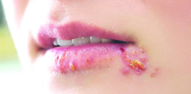 Herpes ở miệng khi quan hệ bằng miệng