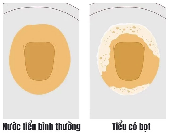 Đi tiểu ra bọt màu trắng cảnh báo bệnh gì?