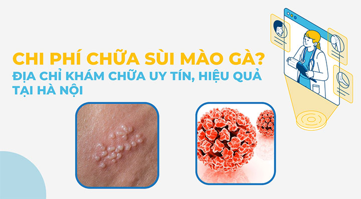 Bệnh viện chữa sùi mào gà ở đâu tốt nhất Hà Nội?