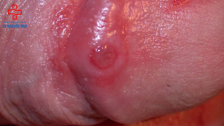 Những nguyên nhân gây dương vật mọc mụn đỏ