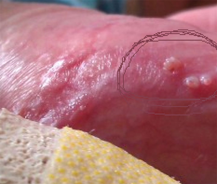 Nguyên nhân dương vật mọc mụn đỏ ngoài bệnh lý