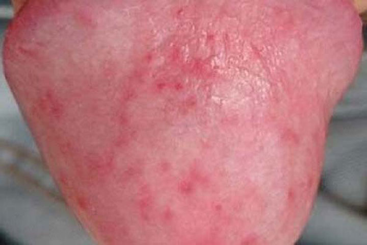 Nam giới nên làm gì khi dương vật mọc mụn đỏ?