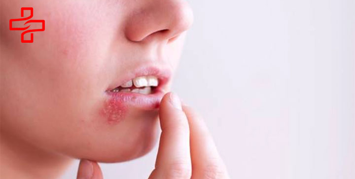 hình ảnh mụn nước sinh dục nam giới 02