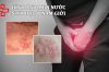 Mụn nước sinh dục nam giới là bệnh gì?