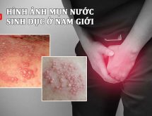 Mụn nước sinh dục nam giới là bệnh gì?