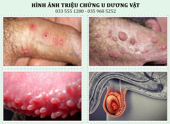 Nguyên nhân gây ra khối u ở bộ phận sinh dục nam giới