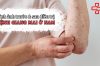 Hình ảnh trước và sau điều trị bệnh giang mai ở nam giới