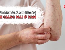 Hình ảnh trước và sau điều trị bệnh giang mai ở nam giới