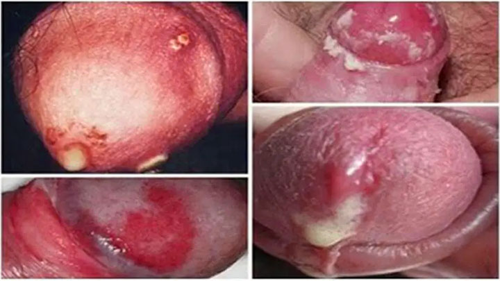 Hình ảnh bệnh lậu giai đoạn đầu ở nam giới