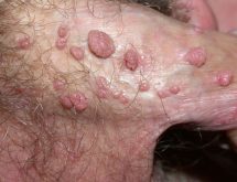 Hình ảnh trước và sau điều trị bệnh sùi mào gà ở nam giới