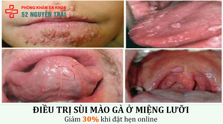 Hình ảnh bệnh sùi mào gà ở miệng lưỡi