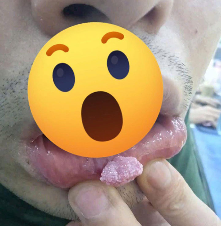 Hình ảnh bệnh sùi mào gà ở miệng nam giới