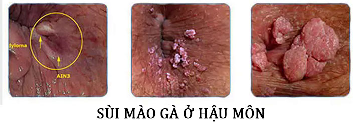 Hình ảnh bệnh sùi mào gà ở hậu môn