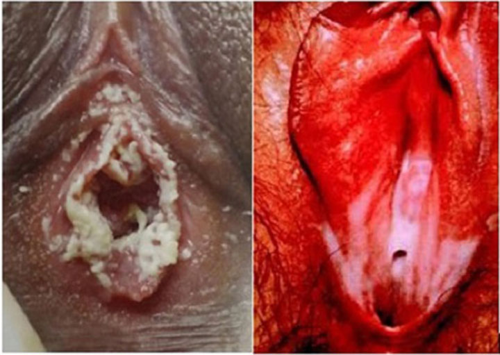 Hình ảnh thực tế trước và sau khi điều trị bệnh lậu ở nữ giới