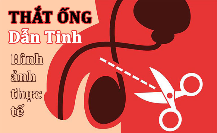 Hình ảnh trước và sau khi thắt ống dẫn tinh