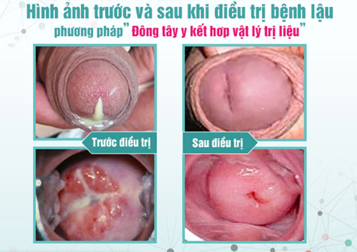 Hình ảnh trước và sau điều trị bệnh lậu ở nam giới