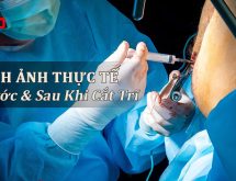 Hình ảnh trước và sau khi cắt trĩ
